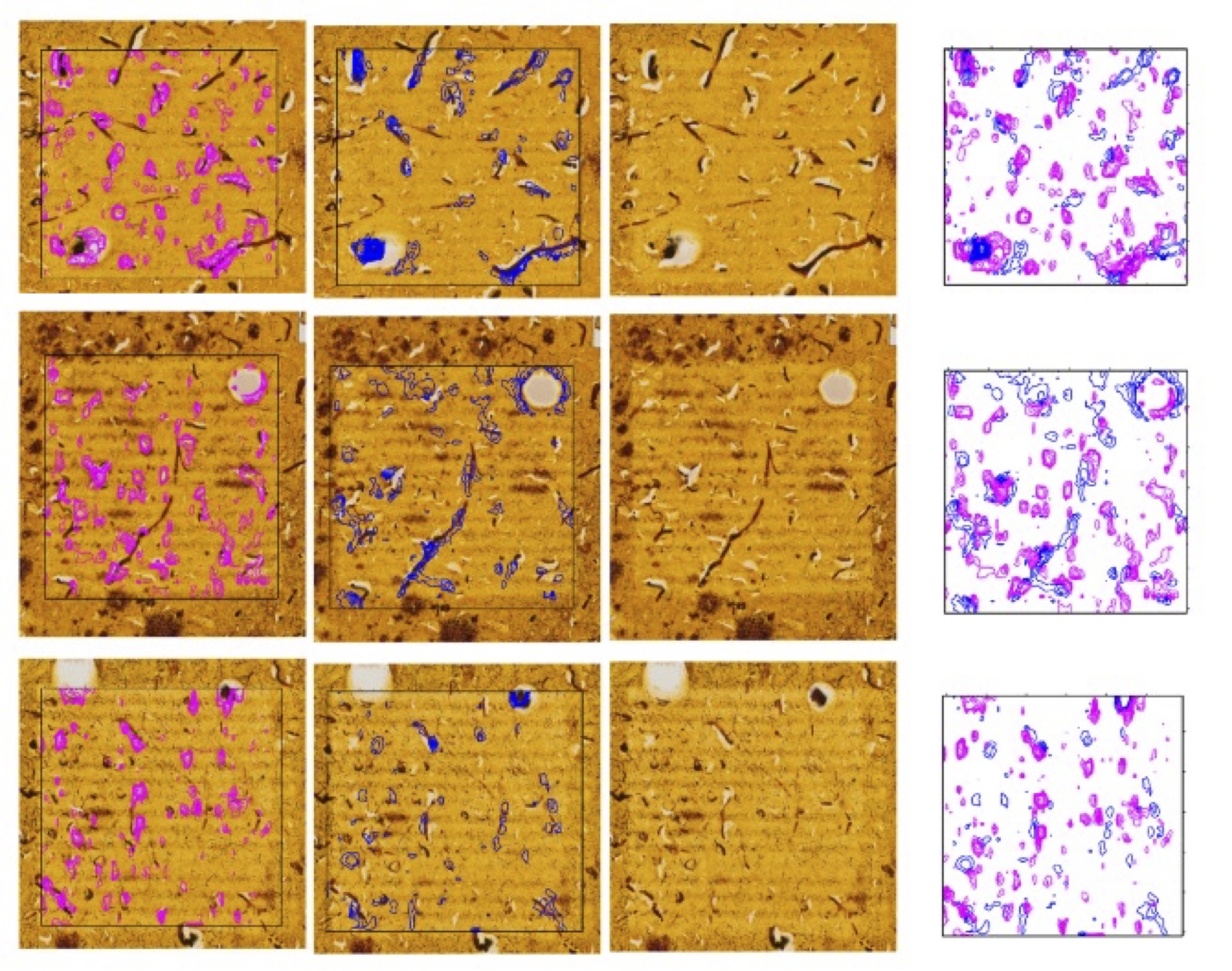 Multi-modal tracking of Protein deposition and clearance in the progression of Alzheimer's disease